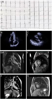 Case Report: Two New Cases of Autosomal-Recessive Hypertrophic Cardiomyopathy Associated With TRIM63-Compound Heterozygous Variant